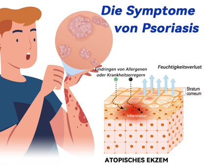 Ourlyard™ Psoriasis Rotierende UVB-Phototherapielampe (Freihändig, Geeignet für alle Hauttypen)