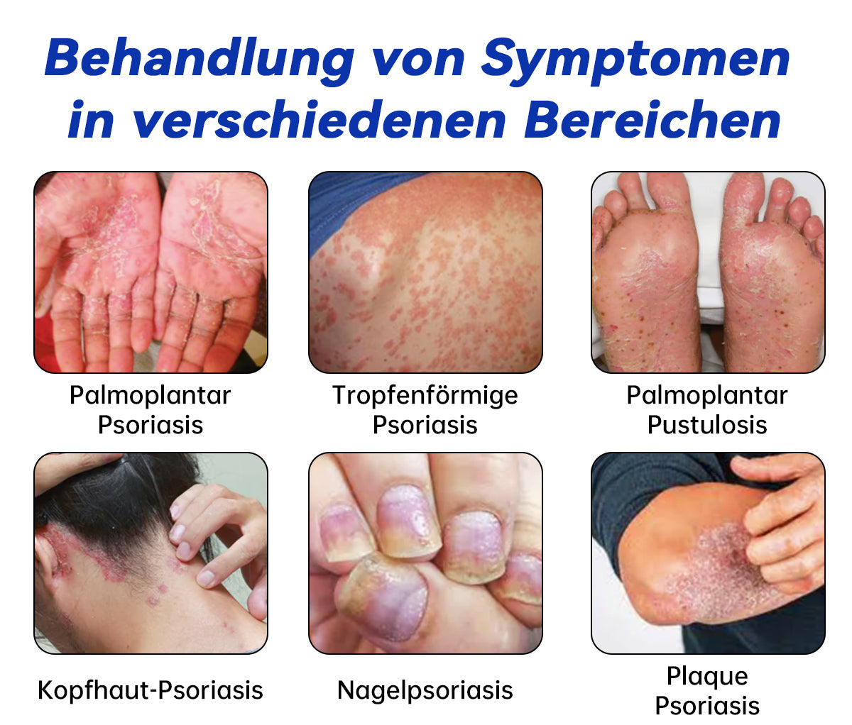 Ourlyard™ Psoriasis Rotierende UVB-Phototherapielampe (Freihändig, Geeignet für alle Hauttypen)