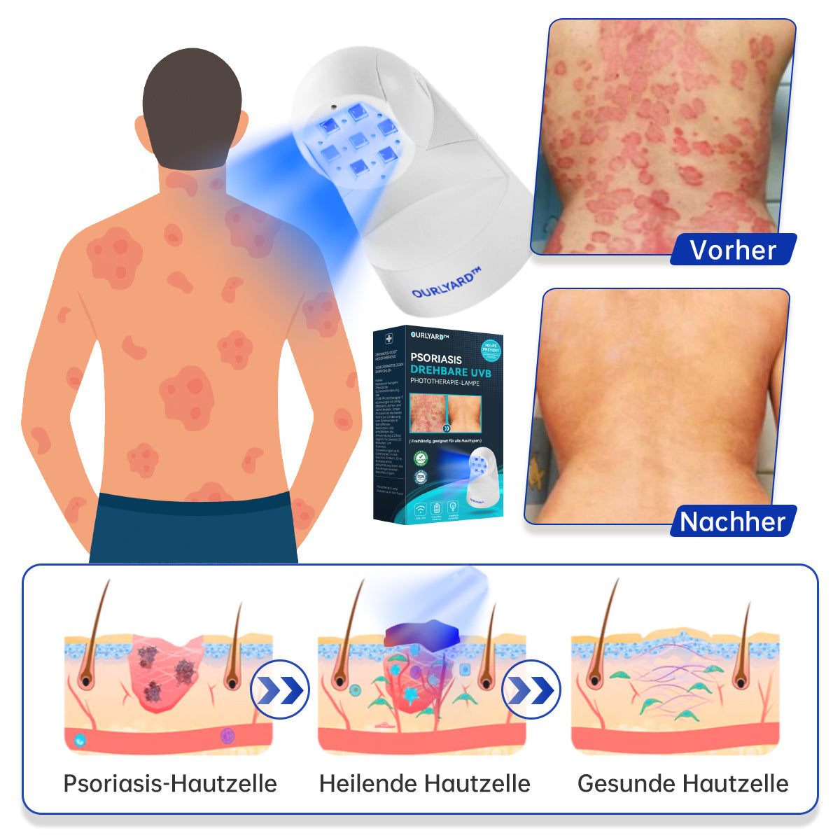 Ourlyard™ Psoriasis Rotierende UVB-Phototherapielampe (Freihändig, Geeignet für alle Hauttypen)